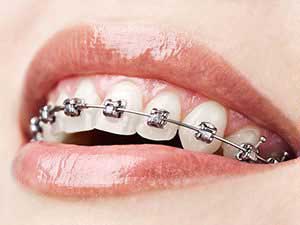 Исправление прикуса (ортодонтия) в СПб — стоматология «Премьера» ☎ +7 (812) 309-00-52