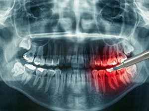 Рентген-диагностика зубов в СПб — стоматология «Премьера» ☎ +7 (812) 309-00-52