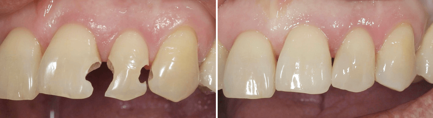 эстетическая реставрация зубов