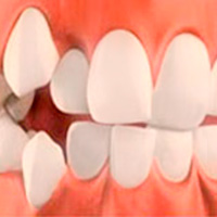 Скученность зубов