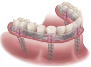 Несъемные зубные протезы под ключ в СПб — стоматология «Премьера» ☎ +7 (812) 309-00-52