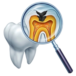 Лечение кариеса в ЖК «Балтийская жемчужина» — стоматология «Премьера» ☎ +7 (812) 607-67-47