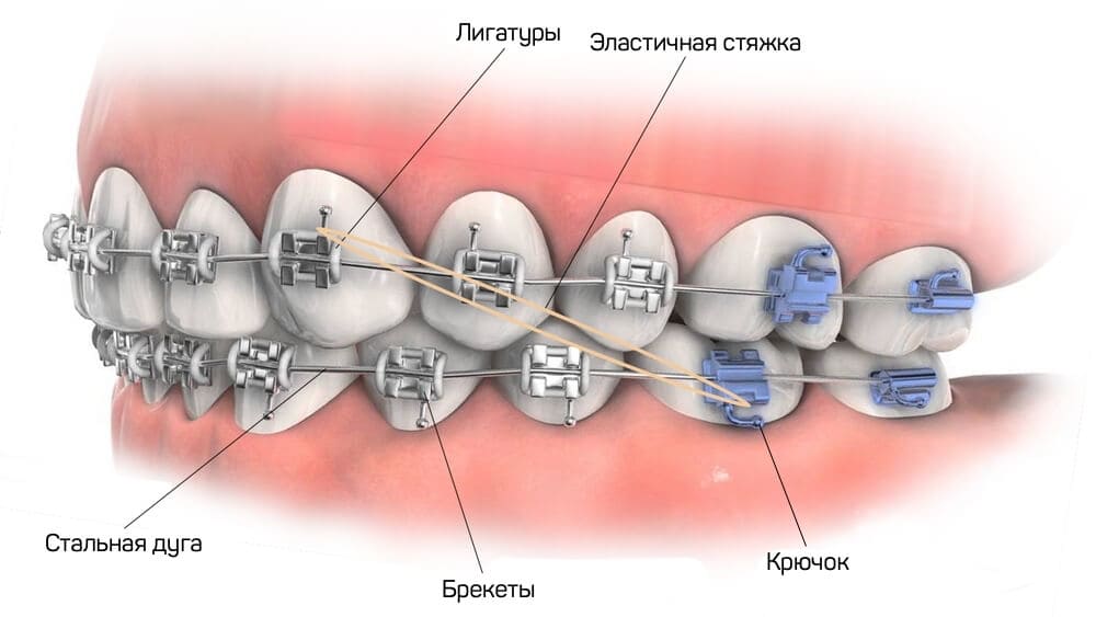 Как устроена брекет-система — Стоматология «Премьера» в Красносельском районе СПб ☎ +7 (812) 309-00-52