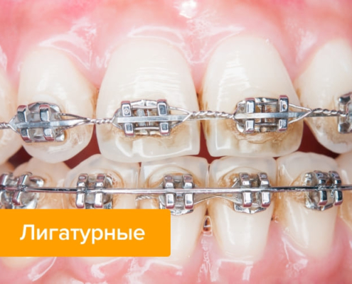 Лигатурные брекеты — стоматология «Премьера» ☎ +7 (812) 309-00-52