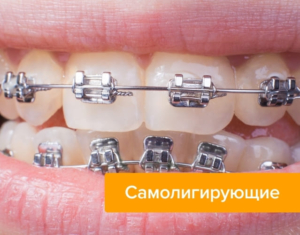 Самолигирующие брекеты — стоматология «Премьера» ☎ +7 (812) 309-00-52