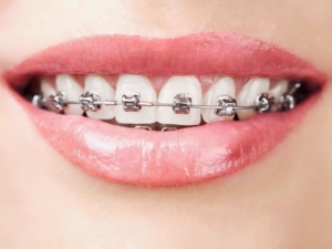 Вестибулярные (внешние) брекеты — стоматология «Премьера» ☎ +7 (812) 309-00-52