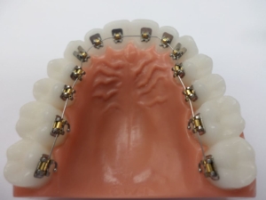 Лингвальные (внутренние) брекеты — стоматология «Премьера» ☎ +7 (812) 309-00-52