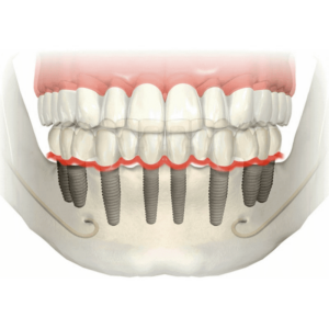 Имплантация нижней челюсти в СПб — стоматология «Премьера» ☎ +7 (812) 309-00-52