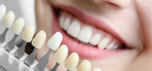 Установка виниров на зубы под ключ в СПб — стоматология «Премьера» ☎ +7 (812) 309-00-52