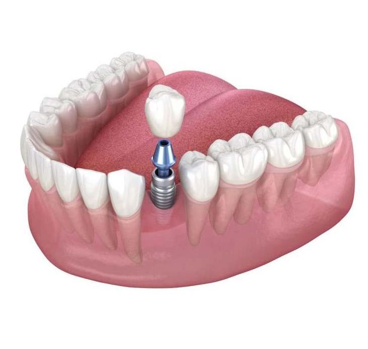 Протезирование зубов на имплантах — «Премьера» на Петергофском 53