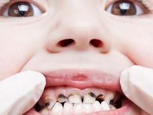 Лечение периодонтита у ребенка в СПб — стоматология «Премьера» ☎ +7 (812) 309-00-52