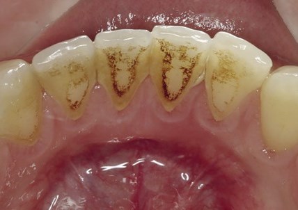 Профессиональная чистка зубов в СПб недорого — стоматология «Премьера» ☎ +7 (812) 309-00-52