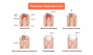 Этапы лечения периодонтита — стоматология «Премьера» ☎ +7 (812) 309-00-52