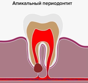 Апикальный периодонтит — стоматология «Премьера» ☎ +7 (812) 309-00-52 Петергофское 53