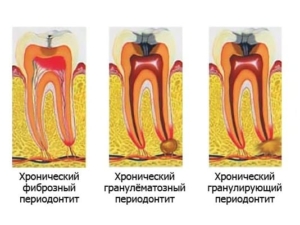 Формы хронического периодонтита — стоматология «Премьера» ☎ +7 (812) 309-00-52 СПб