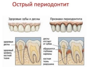 Острый периодонтит — стоматология «Премьера» ☎ +7 (812) 309-00-52