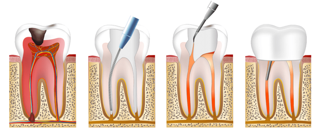 Лечение корневых каналов при периодонтите — стоматология «Премьера» ☎ +7 (812) 607-67-47