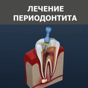 Лечение периодонтита в СПб — стоматология «Премьера» ☎ +7 (812) 607-67-47