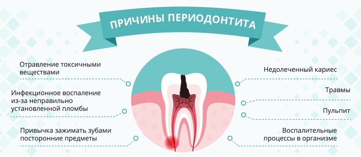 Осложнение лечения периодонтита. Хронический периодонтит зуба 55. Профилактика периодонтита.