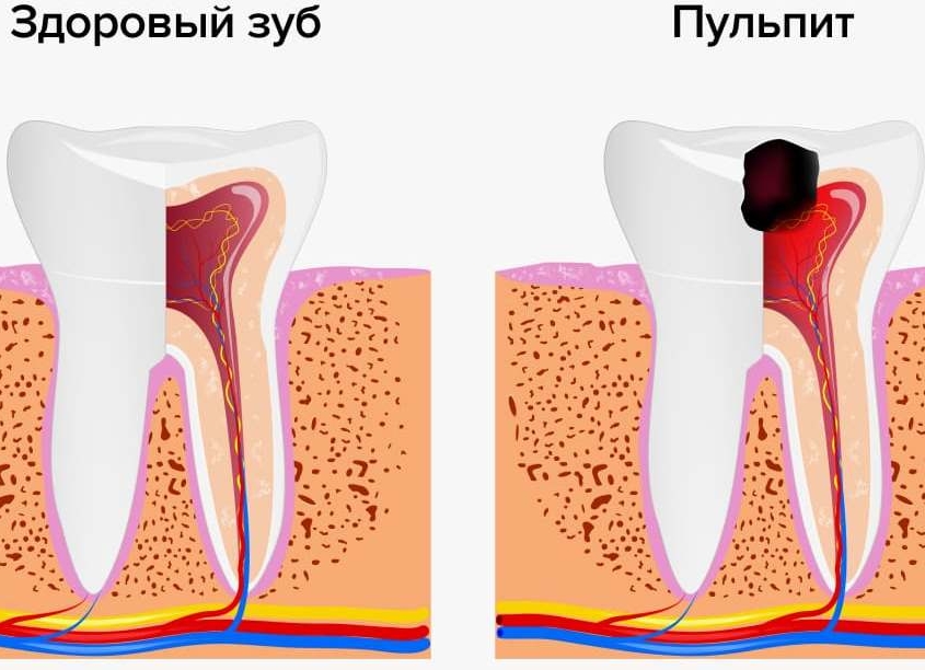 Лечение пульпита зубов в Санкт-Петербурге — стоматология «Премьера» ☎ +7 (812) 309-00-52