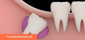 Ретинированный зуб мудрости — стоматология «Премьера» ☎ +7 (812) 309-00-52