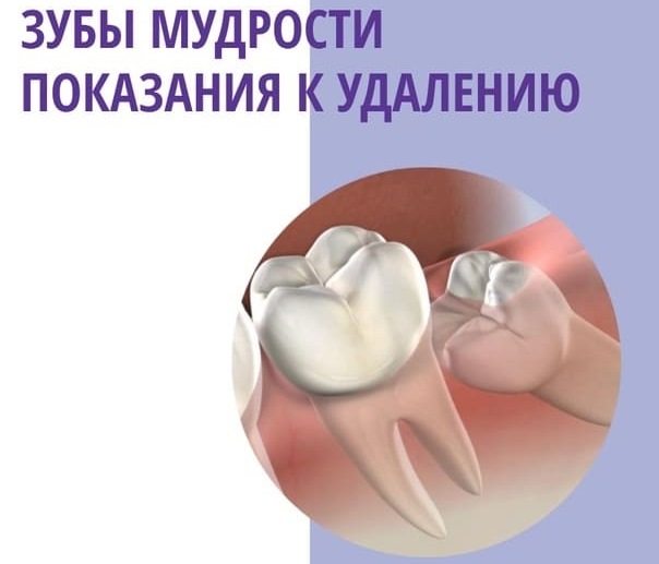 Показания к удалению зубов мудрости — стоматология «Премьера» ☎ +7 (812) 309-00-52