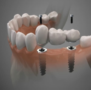 Недорогое несъемное протезирование зубов в СПб — стоматология «Премьера» ☎ +7 (812) 309-00-52