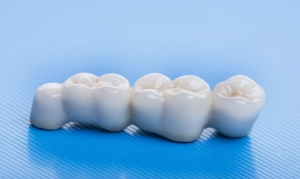 Несъемные зубные мосты в СПб под ключ — стоматология «Премьера» ☎ +7 (812) 309-00-52