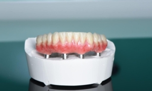 Несъемные протезы на имплантах недорого — стоматология «Премьера» ☎ +7 (812) 309-00-52 СПб