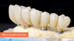 Зубной мост на имплантатах — стоматология «Премьера» ☎ +7 (812) 309-00-52