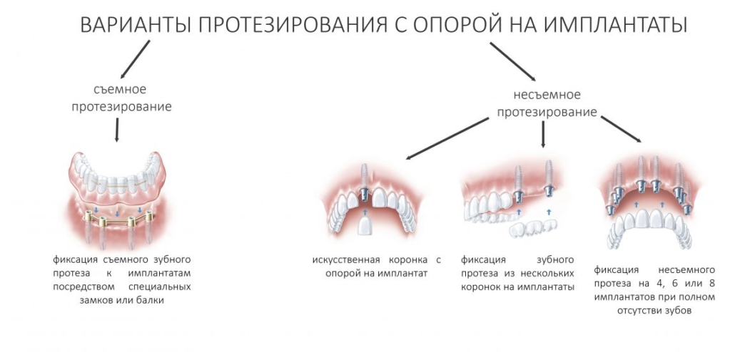 Протезирование с опорой на импланты в СПб под ключ — стоматология «Премьера» ☎ +7 (812) 309-00-52