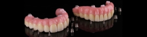 Зубные протезы на имплантах в СПб — стоматология «Премьера» ☎ +7 (812) 309-00-52