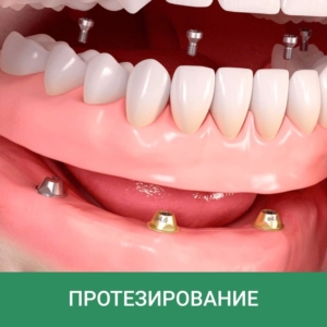 Протезы на имплантах в Санкт-Петербурге — стоматология «Премьера» ☎ +7 (812) 309-00-52