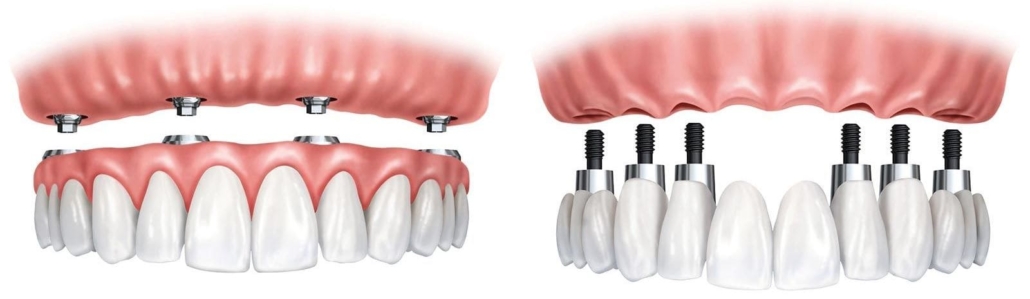Протезирование зубов на имплантах под ключ — стоматология «Премьера» ☎ +7 (812) 309-00-52 СПб