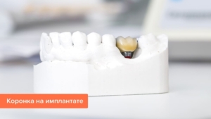 Коронка на импланте — стоматология «Премьера» ☎ +7 (812) 309-00-52