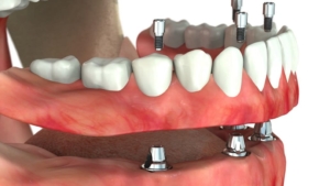 Полный протез на имплантатах — стоматология «Премьера» ☎ +7 (812) 309-00-52