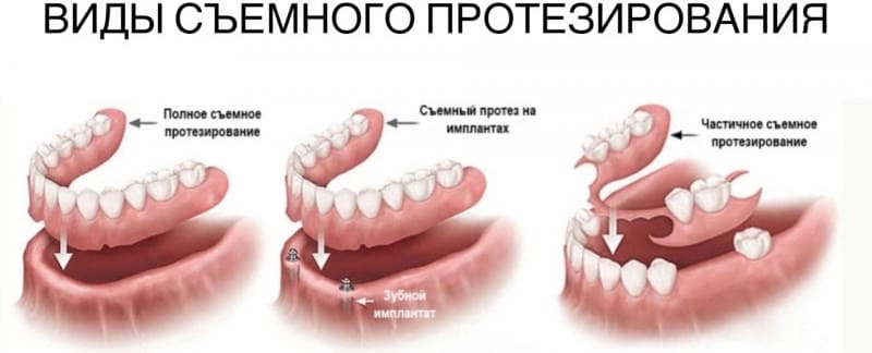 Протезирование зубов съемными протезами в СПб — стоматология «Премьера» ☎ +7 (812) 309-00-52