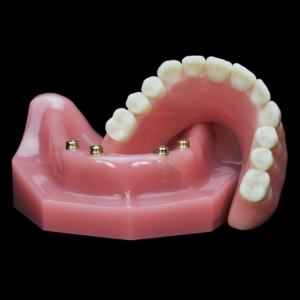 Условно-съемные зубные протезы — стоматология «Премьера» ☎ +7 (812) 309-00-52