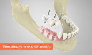 Нижняя челюсть на имплантах — стоматология «Премьера» ☎ +7 (812) 309-00-52