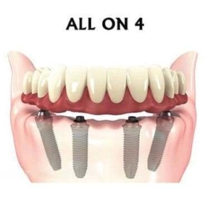 Имплантация при полном отсутствии нижних зубов — «Премьера» ☎ +7 (812) 309-00-52