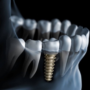 Имплантация нижних зубов под ключ в СПб — стоматология «Премьера» ☎ +7 (812) 309-00-52