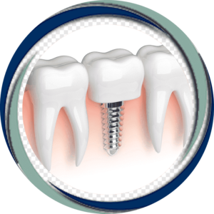Имплантация зубов на нижней челюсти под ключ — «Премьера» ☎ +7 (812) 309-00-52 Петергофское 53