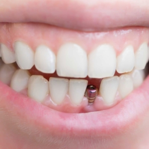 Имплантация передних зубов на нижней челюсти в СПб — «Премьера» ☎ +7 (812) 309-00-52