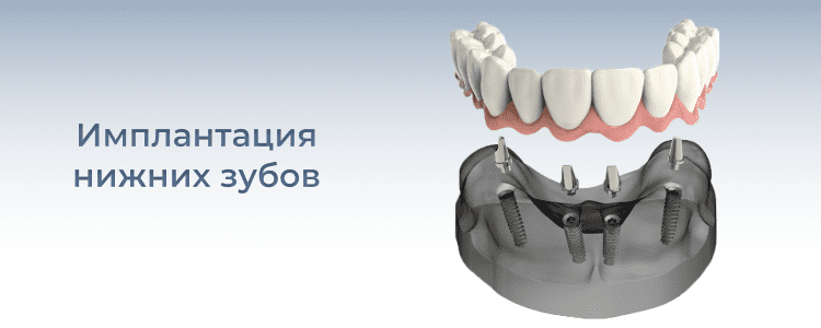 Нижняя челюсть на имплантах под ключ в СПб — «Премьера» ☎ +7 (812) 309-00-52