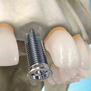 Импланты на верхнюю челюсть под ключ в СПб — стоматология «Премьера» ☎ +7 (812) 309-00-52
