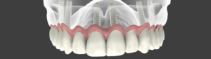 Имплантация верхних зубов в СПб — стоматология «Премьера» ☎ +7 (812) 309-00-52