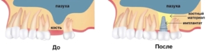 Имплантация и синус-лифтинг в СПб — стоматология «Премьера» ☎ +7 (812) 309-00-52