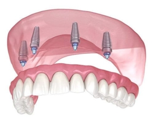 Полная имплантация зубов верхней челюсти — «Премьера» на Петергофском ☎ +7 (812) 309-00-52