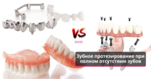 Полное протезирование зубов в СПб недорого — стоматология «Премьера» ☎ +7 (812) 309-00-52
