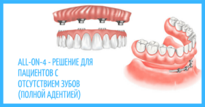 Полное протезирование зубов All-On-4 в СПб — стоматология «Премьера» ☎ +7 (812) 309-00-52